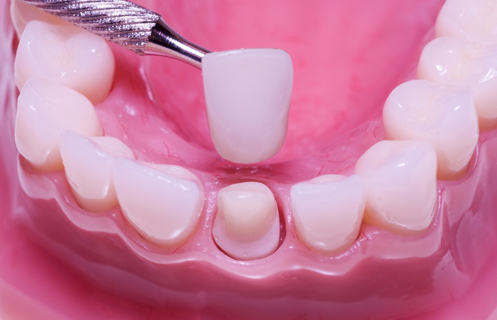 dental crowns