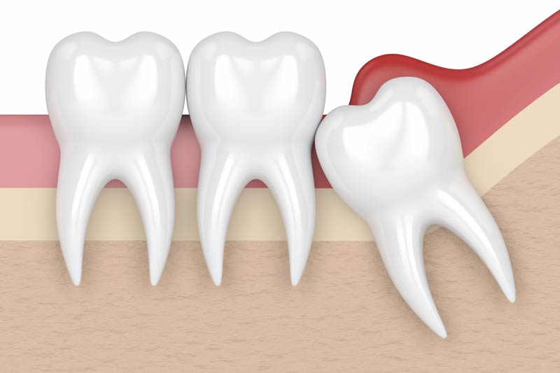 Wisdom Teeth Removal in Spring